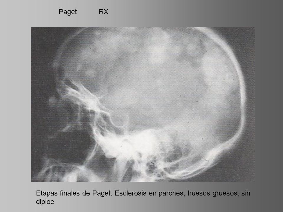 Paget RX Etapas finales de Paget. Esclerosis en parches, huesos gruesos, sin diploe