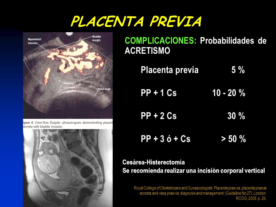 PLACENTA PREVIA Placenta previa 5 % PP + 1 Cs % PP + 2 Cs 30 %