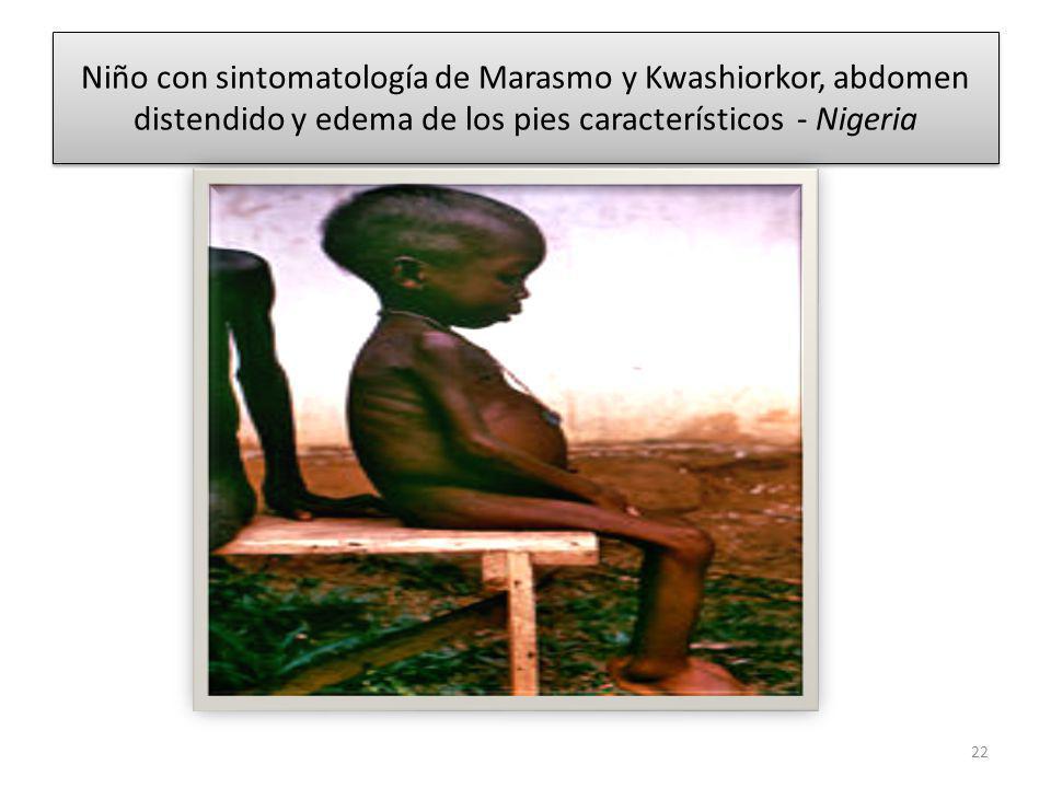 Niño con sintomatología de Marasmo y Kwashiorkor, abdomen distendido y edema de los pies característicos - Nigeria