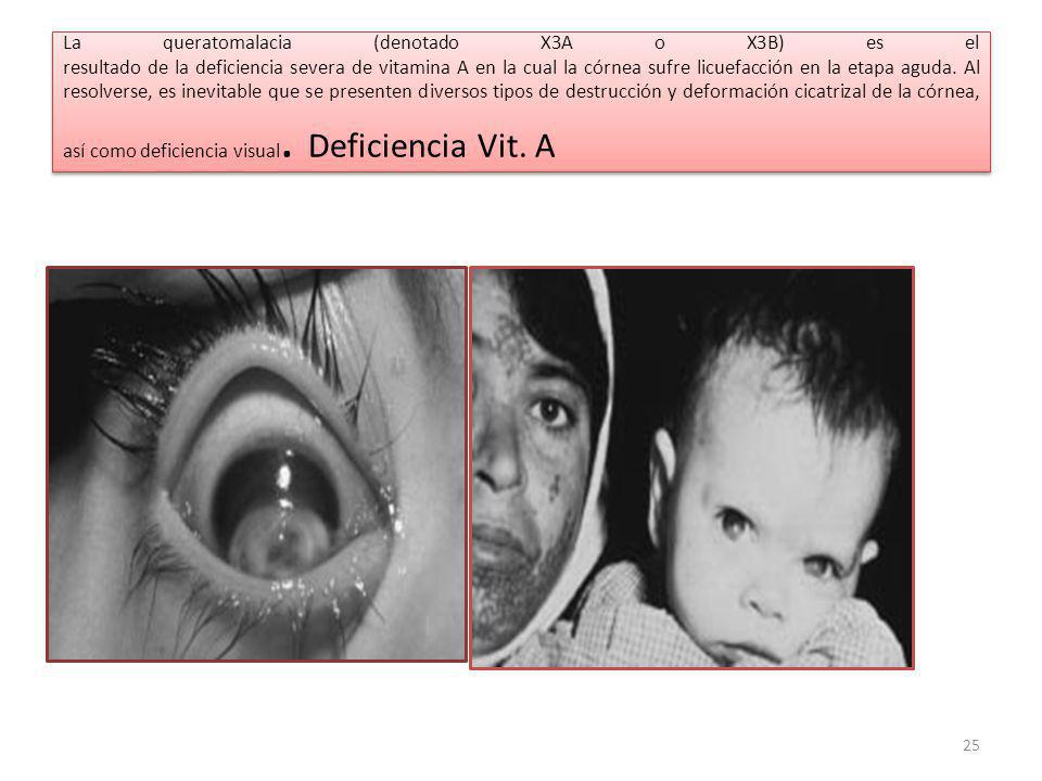 La queratomalacia (denotado X3A o X3B) es el resultado de la deficiencia severa de vitamina A en la cual la córnea sufre licuefacción en la etapa aguda.