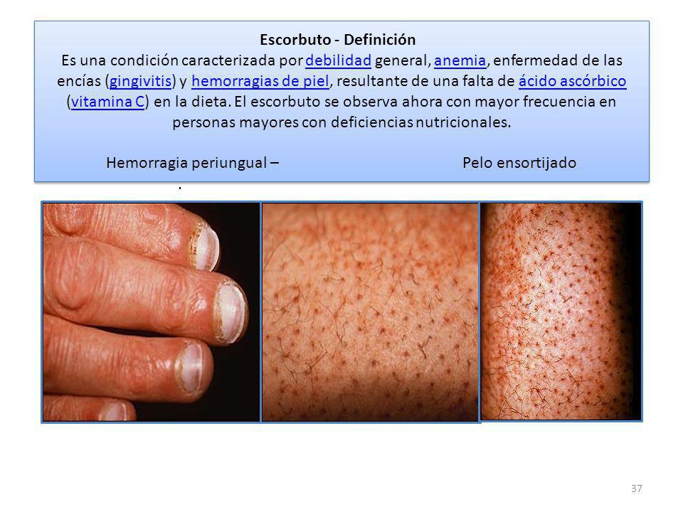 Escorbuto - Definición Es una condición caracterizada por debilidad general, anemia, enfermedad de las encías (gingivitis) y hemorragias de piel, resultante de una falta de ácido ascórbico (vitamina C) en la dieta. El escorbuto se observa ahora con mayor frecuencia en personas mayores con deficiencias nutricionales. Hemorragia periungual – Pelo ensortijado