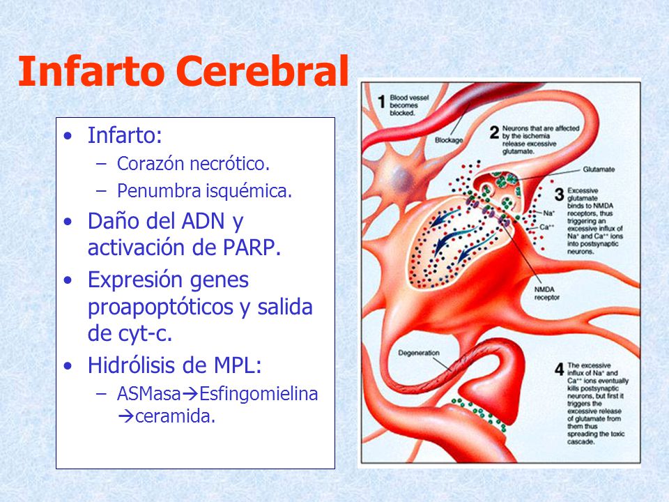 Infarto Cerebral Infarto: Daño del ADN y activación de PARP.