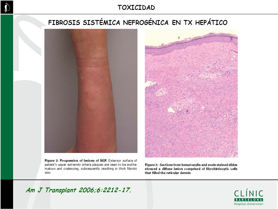 TOXICIDAD FIBROSIS SISTÉMICA NEFROGÉNICA EN TX HEPÁTICO Am J Transplant 2006;6: