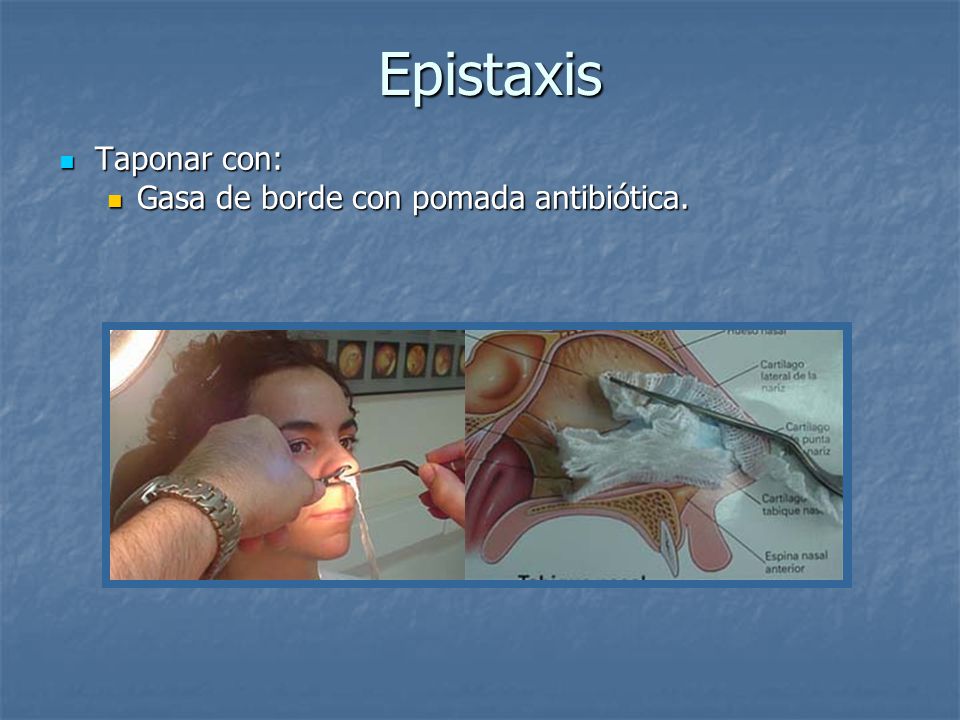 Epistaxis Taponar con: Gasa de borde con pomada antibiótica.