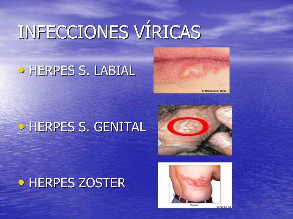 INFECCIONES VÍRICAS HERPES S. LABIAL HERPES S. GENITAL HERPES ZOSTER