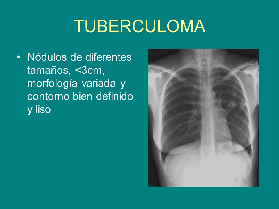 TUBERCULOMA Nódulos de diferentes tamaños, <3cm, morfología variada y contorno bien definido y liso