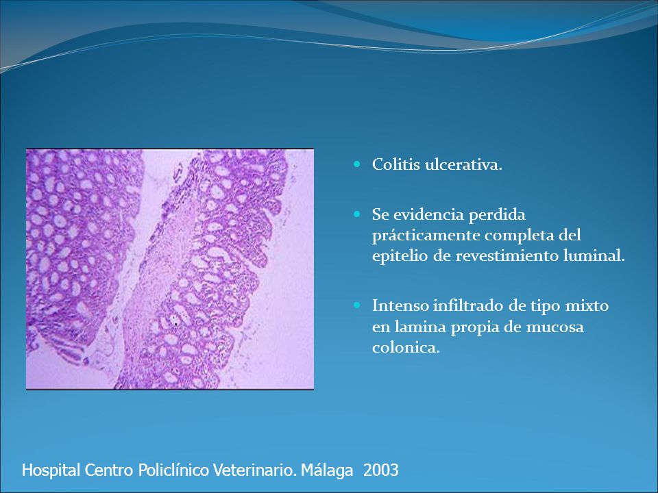 Intenso infiltrado de tipo mixto en lamina propia de mucosa colonica.