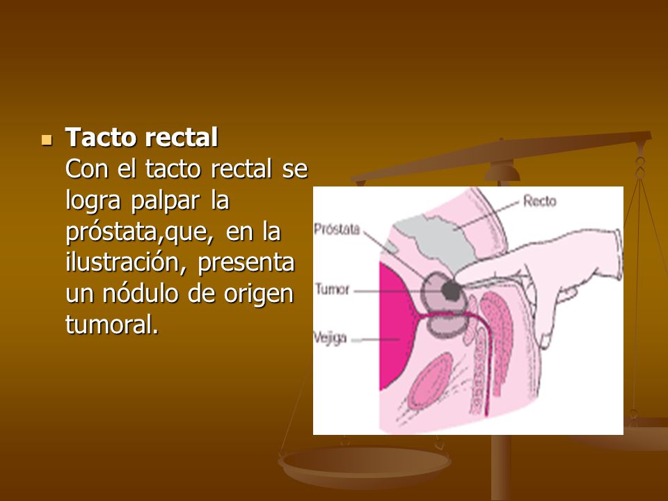 Tacto rectal Con el tacto rectal se logra palpar la próstata,que, en la ilustración, presenta un nódulo de origen tumoral.