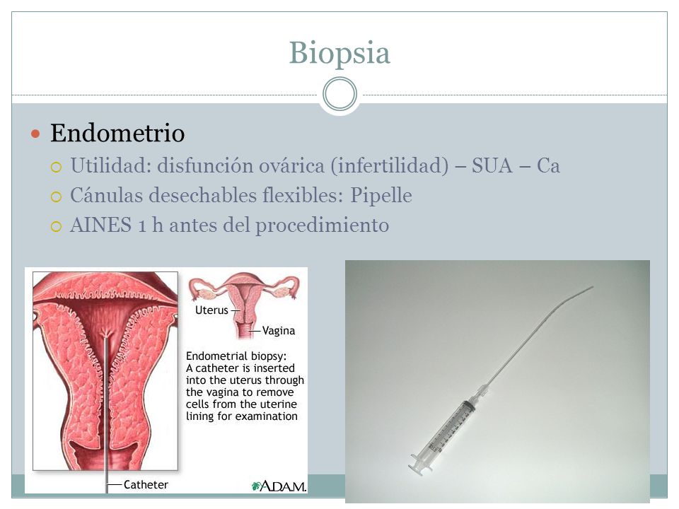 Biopsia Endometrio. Utilidad: disfunción ovárica (infertilidad) – SUA – Ca. Cánulas desechables flexibles: Pipelle.