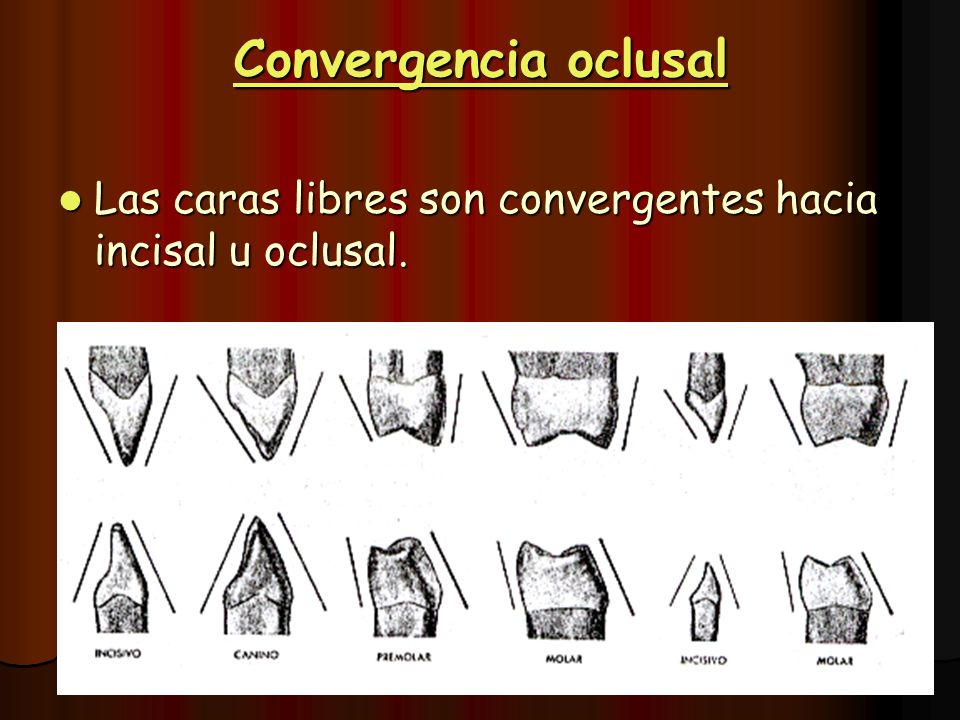 Convergencia oclusal Las caras libres son convergentes hacia incisal u oclusal.