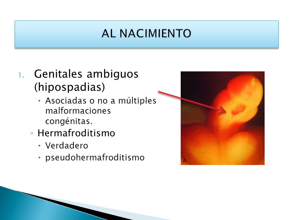 AL NACIMIENTO Genitales ambiguos (hipospadias) Hermafroditismo