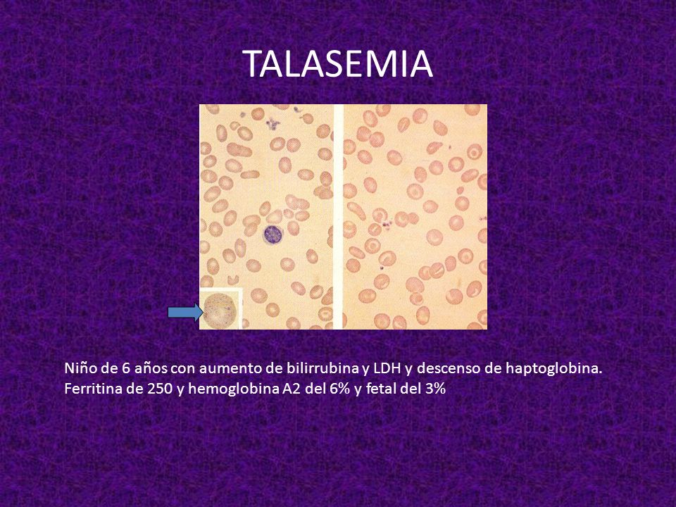 TALASEMIA Niño de 6 años con aumento de bilirrubina y LDH y descenso de haptoglobina.