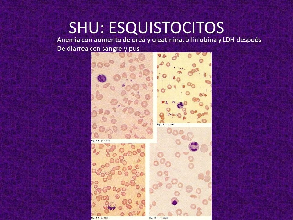 SHU: ESQUISTOCITOS Anemia con aumento de urea y creatinina, bilirrubina y LDH después.