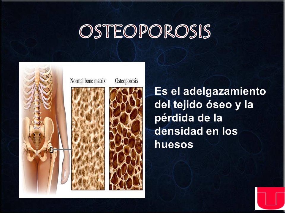 OSTEOPOROSIS Es el adelgazamiento del tejido óseo y la pérdida de la densidad en los huesos