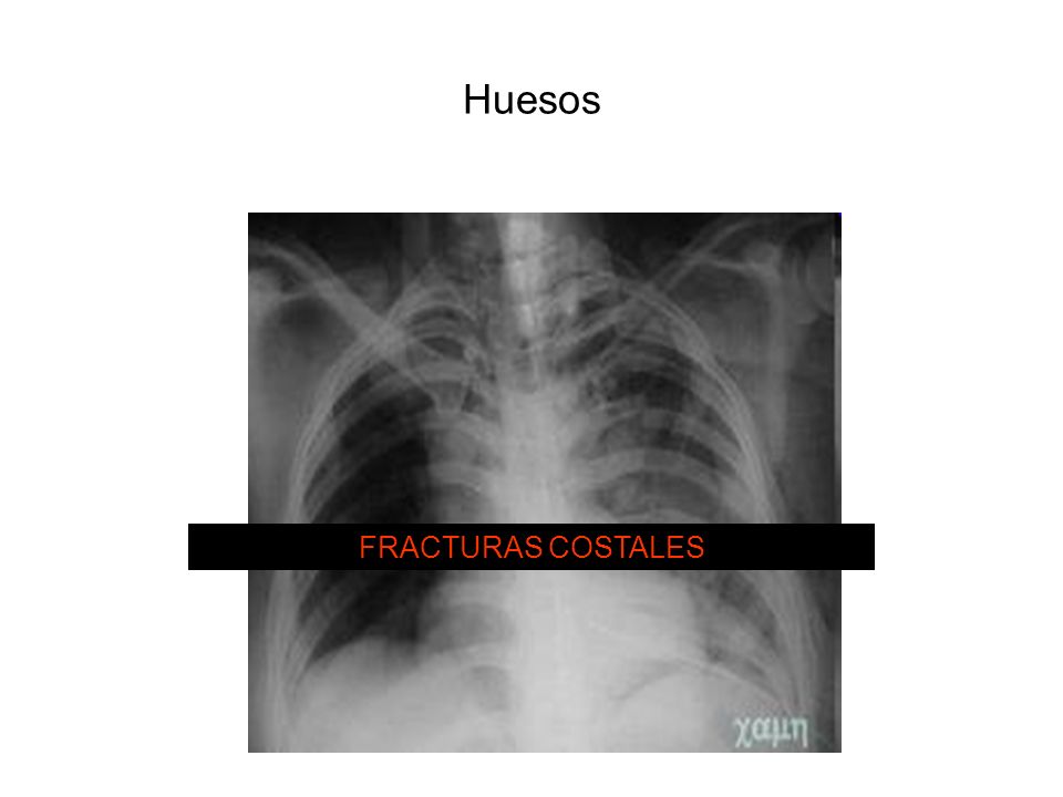 Huesos FRACTURAS COSTALES