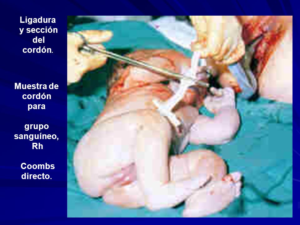 Ligadura y sección del cordón. Muestra de cordón para grupo sanguíneo, Rh Coombs directo.
