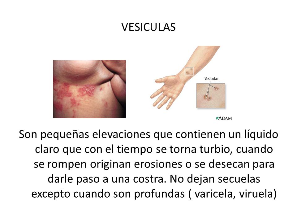 VESICULAS Son pequeñas elevaciones que contienen un líquido claro que con el tiempo se torna turbio, cuando se rompen originan erosiones o se desecan para darle paso a una costra.