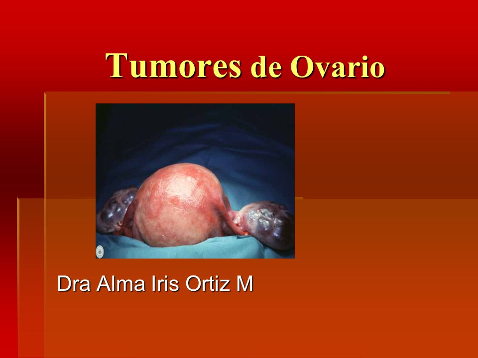 Tumores de Ovario Dra Alma Iris Ortiz M