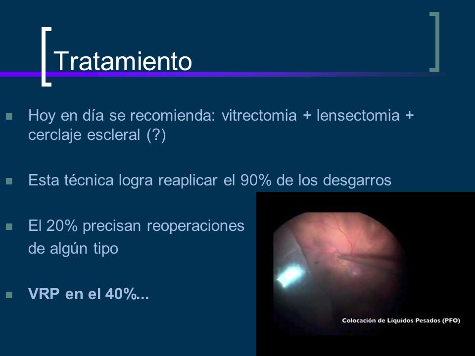 Tratamiento Hoy en día se recomienda: vitrectomia + lensectomia + cerclaje escleral ( ) Esta técnica logra reaplicar el 90% de los desgarros.