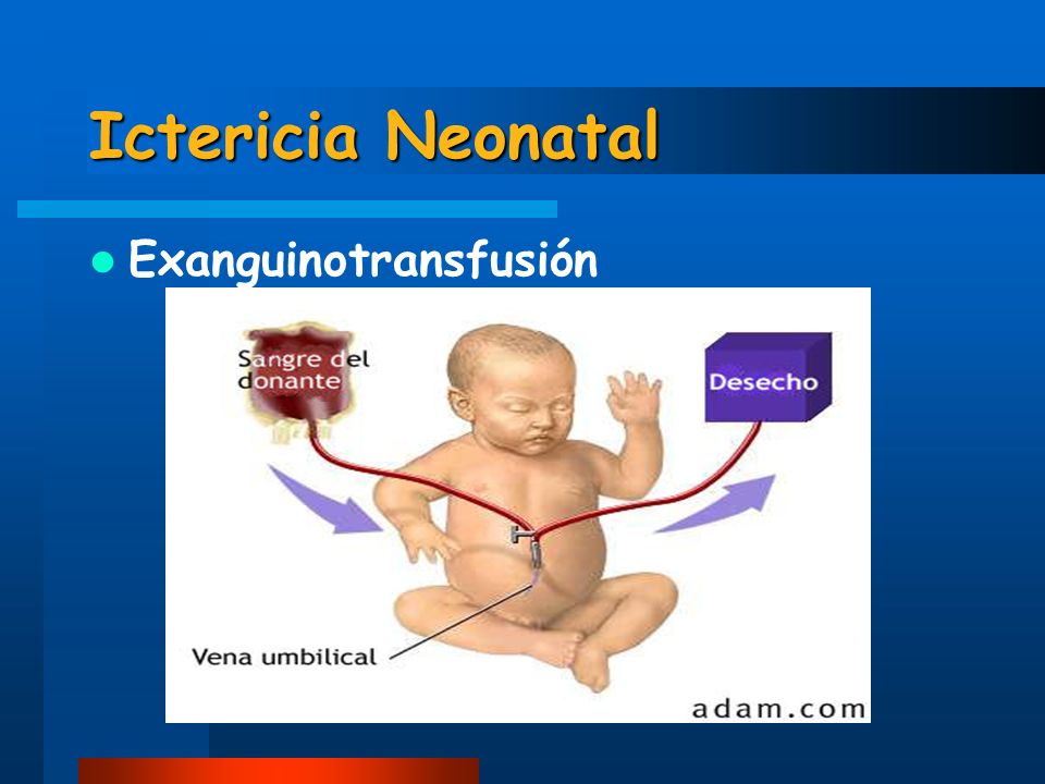 Ictericia Neonatal Exanguinotransfusión