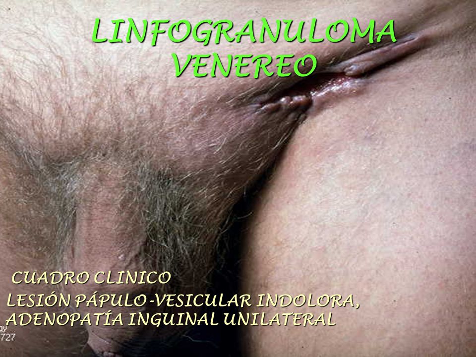 LINFOGRANULOMA VENEREO