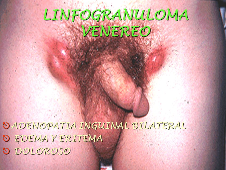 LINFOGRANULOMA VENEREO