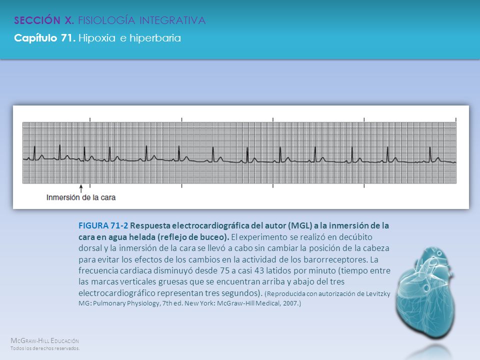 FIGURA 71-2 Respuesta electrocardiográfica del autor (MGL) a la inmersión de la cara en agua helada (reflejo de buceo).