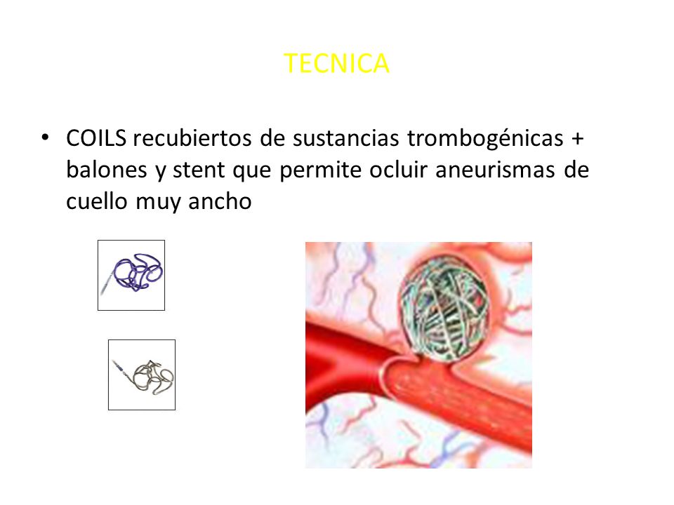 TECNICA COILS recubiertos de sustancias trombogénicas + balones y stent que permite ocluir aneurismas de cuello muy ancho.