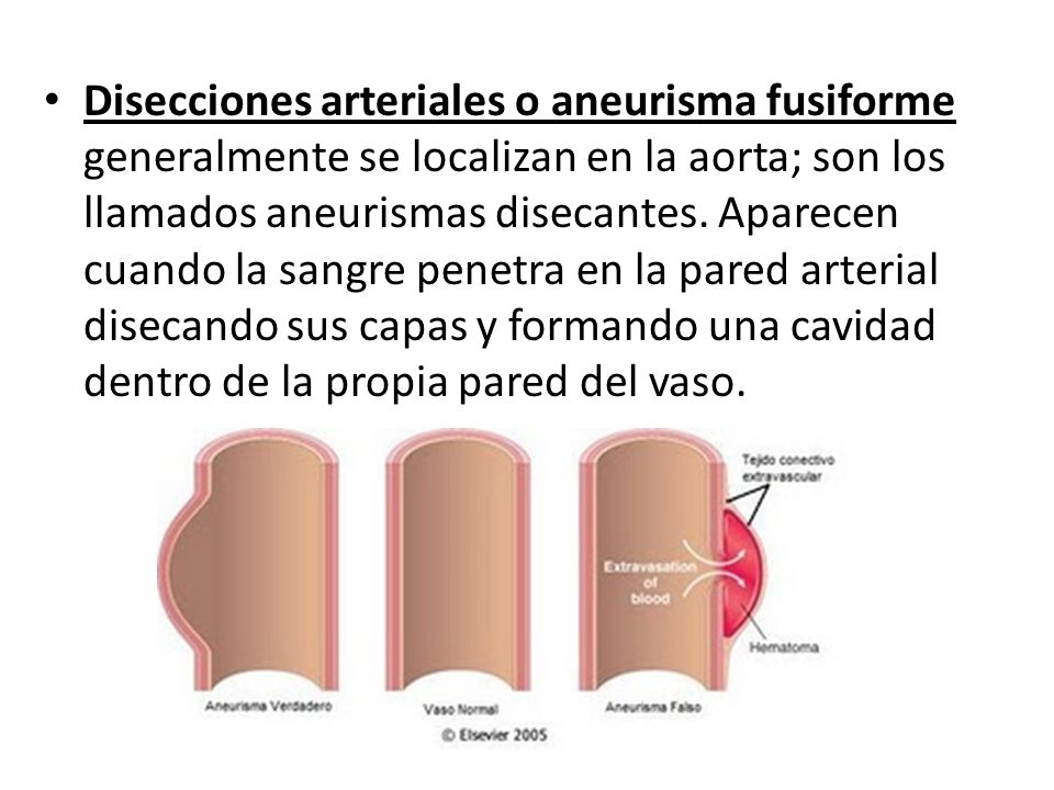 Disecciones arteriales o aneurisma fusiforme generalmente se localizan en la aorta; son los llamados aneurismas disecantes.