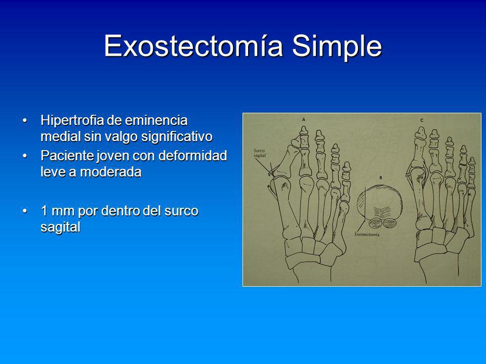 Exostectomía Simple Hipertrofia de eminencia medial sin valgo significativo. Paciente joven con deformidad leve a moderada.