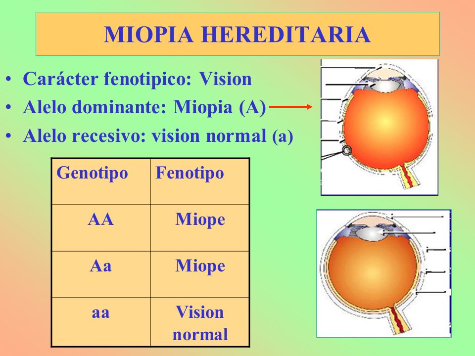 MIOPIA HEREDITARIA Carácter fenotipico: Vision