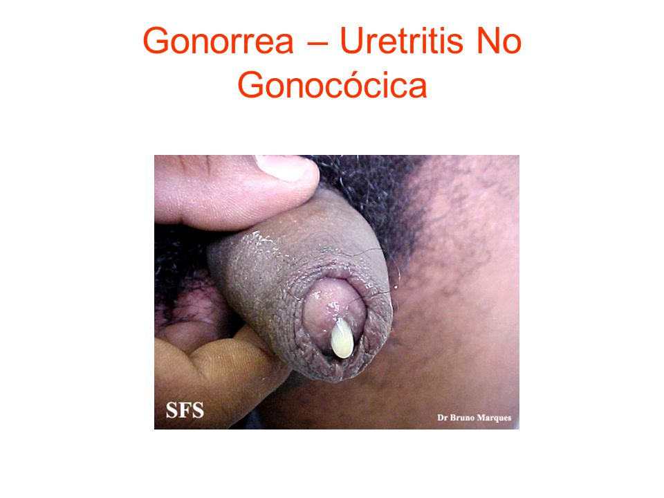 Gonorrea – Uretritis No Gonocócica