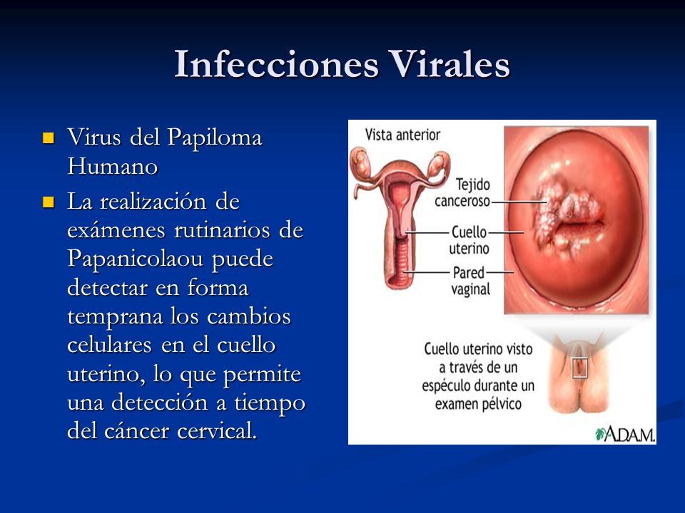 Infecciones Virales Virus del Papiloma Humano