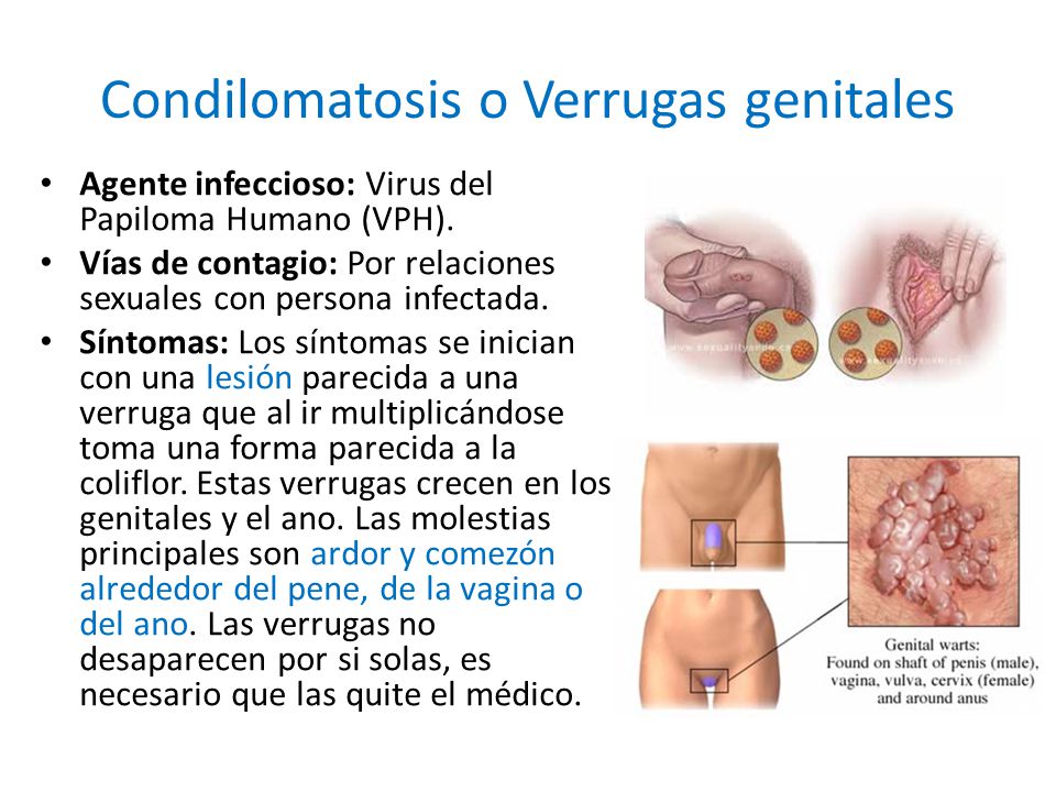 Condilomatosis o Verrugas genitales