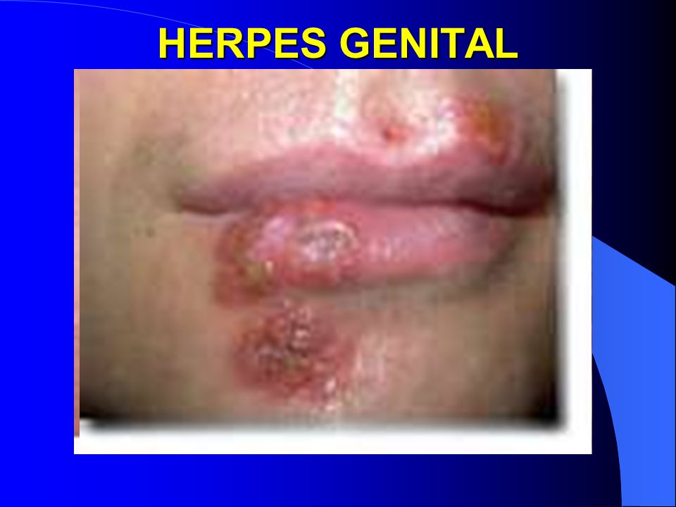 HERPES GENITAL