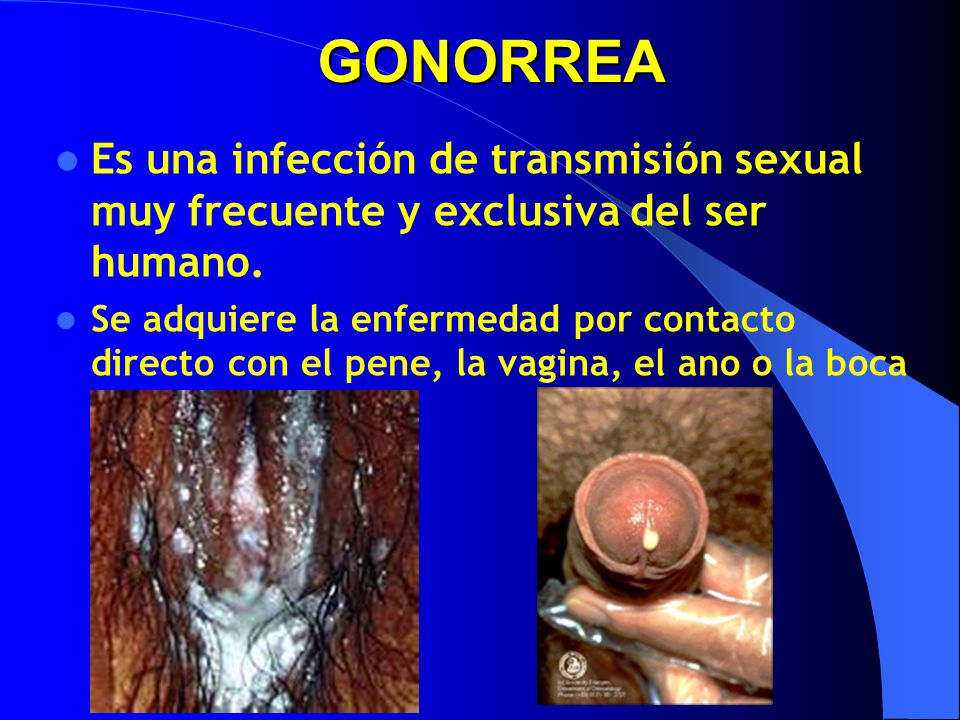 GONORREA Es una infección de transmisión sexual muy frecuente y exclusiva del ser humano.