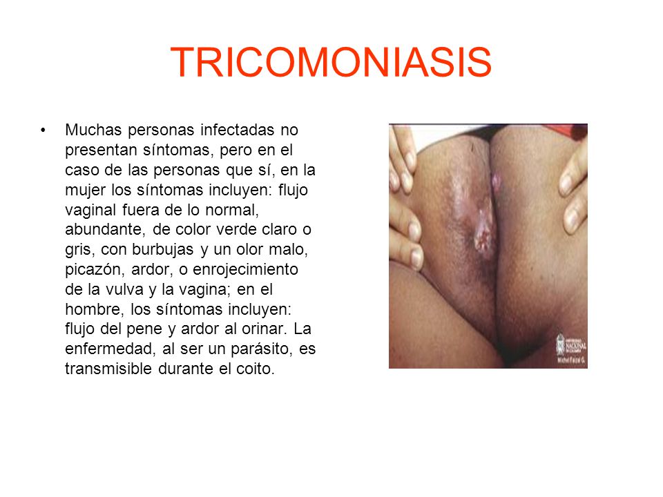 TRICOMONIASIS