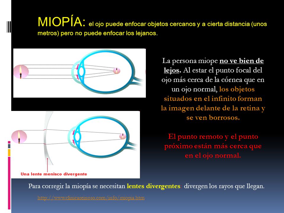MIOPÍA: el ojo puede enfocar objetos cercanos y a cierta distancia (unos metros) pero no puede enfocar los lejanos.