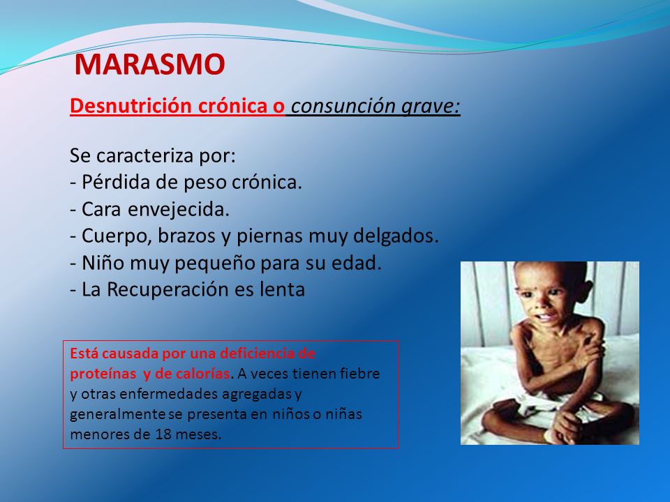 MARASMO Desnutrición crónica o consunción grave: Se caracteriza por: