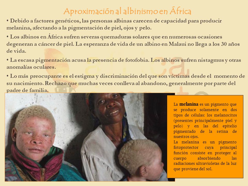 Aproximación al albinismo en África