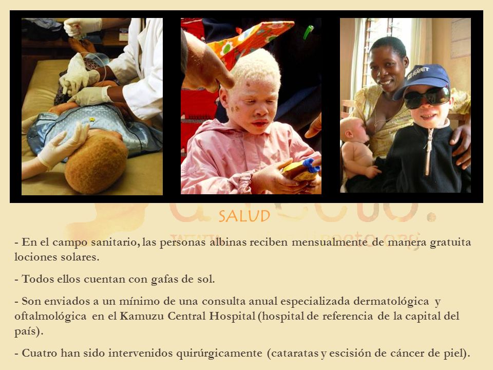 SALUD - En el campo sanitario, las personas albinas reciben mensualmente de manera gratuita lociones solares.