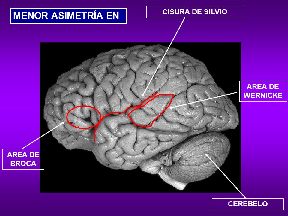 MENOR ASIMETRÍA EN CISURA DE SILVIO AREA DE WERNICKE AREA DE BROCA