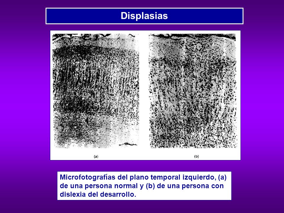 Displasias Microfotografías del plano temporal izquierdo, (a) de una persona normal y (b) de una persona con dislexia del desarrollo.