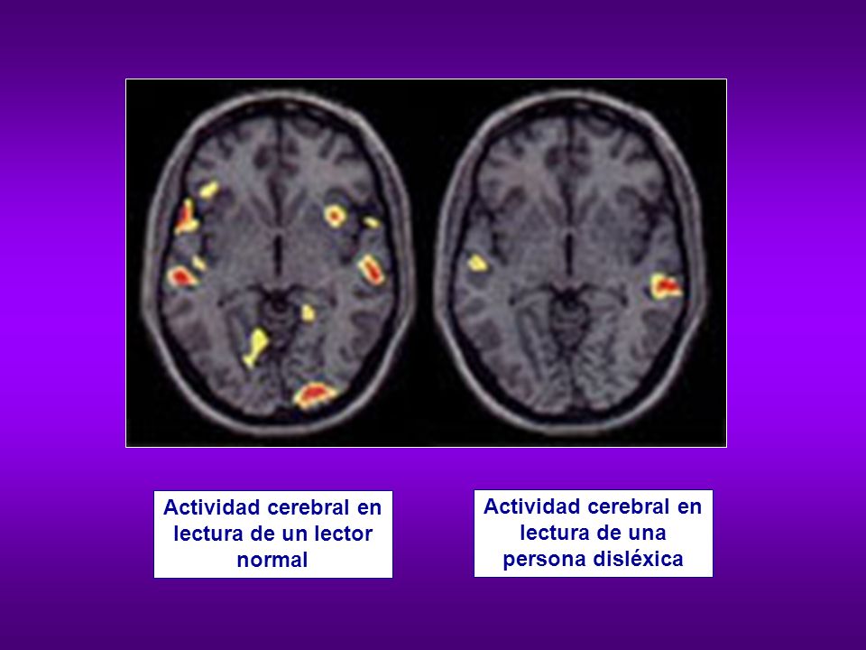 Actividad cerebral en lectura de un lector normal