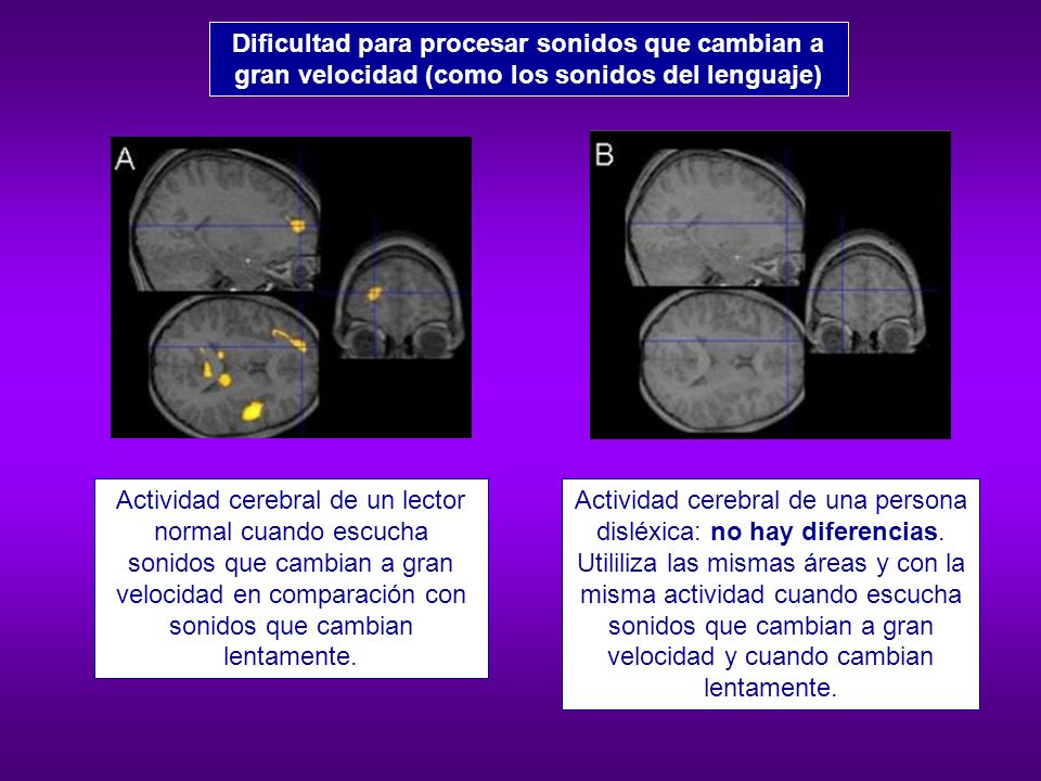 Dificultad para procesar sonidos que cambian a gran velocidad (como los sonidos del lenguaje)