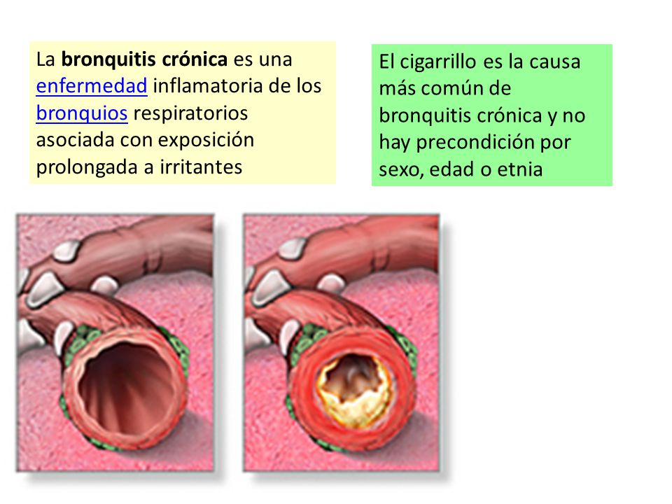 La bronquitis crónica es una enfermedad inflamatoria de los bronquios respiratorios asociada con exposición prolongada a irritantes