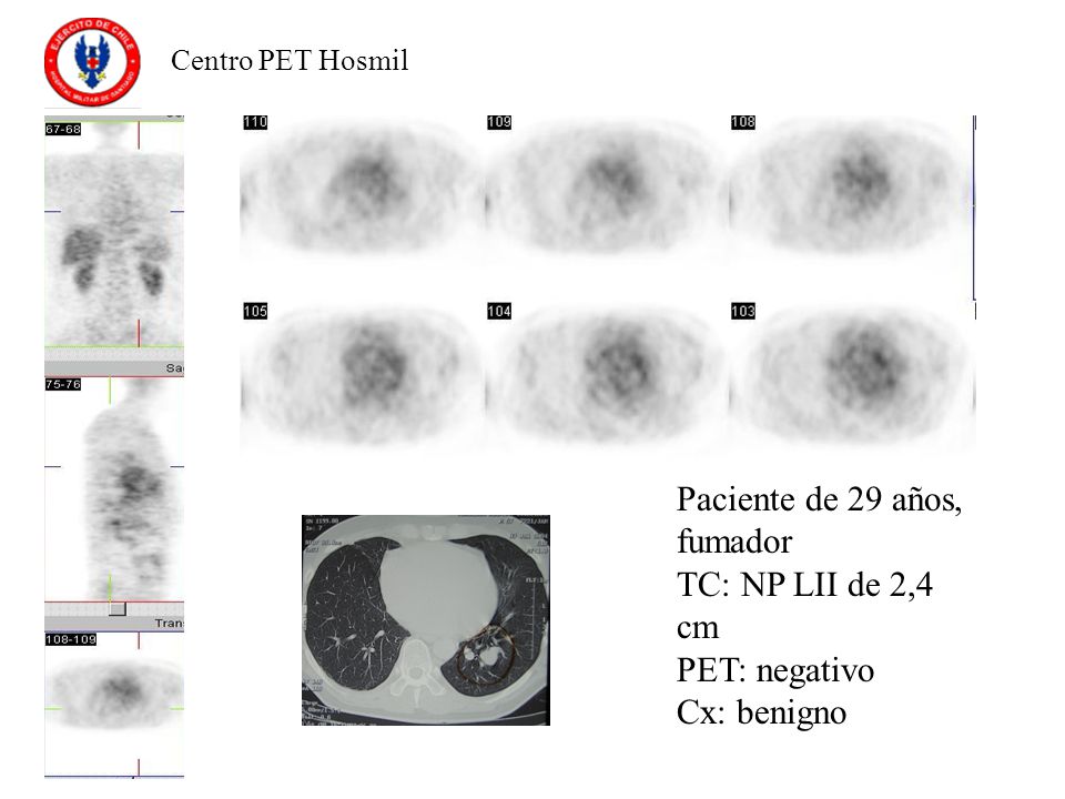 Paciente de 29 años, fumador TC: NP LII de 2,4 cm PET: negativo