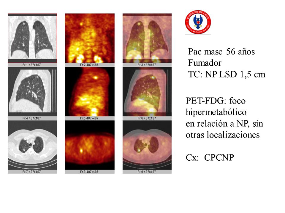 Pac masc 56 años Fumador. TC: NP LSD 1,5 cm. PET-FDG: foco. hipermetabólico. en relación a NP, sin otras localizaciones.