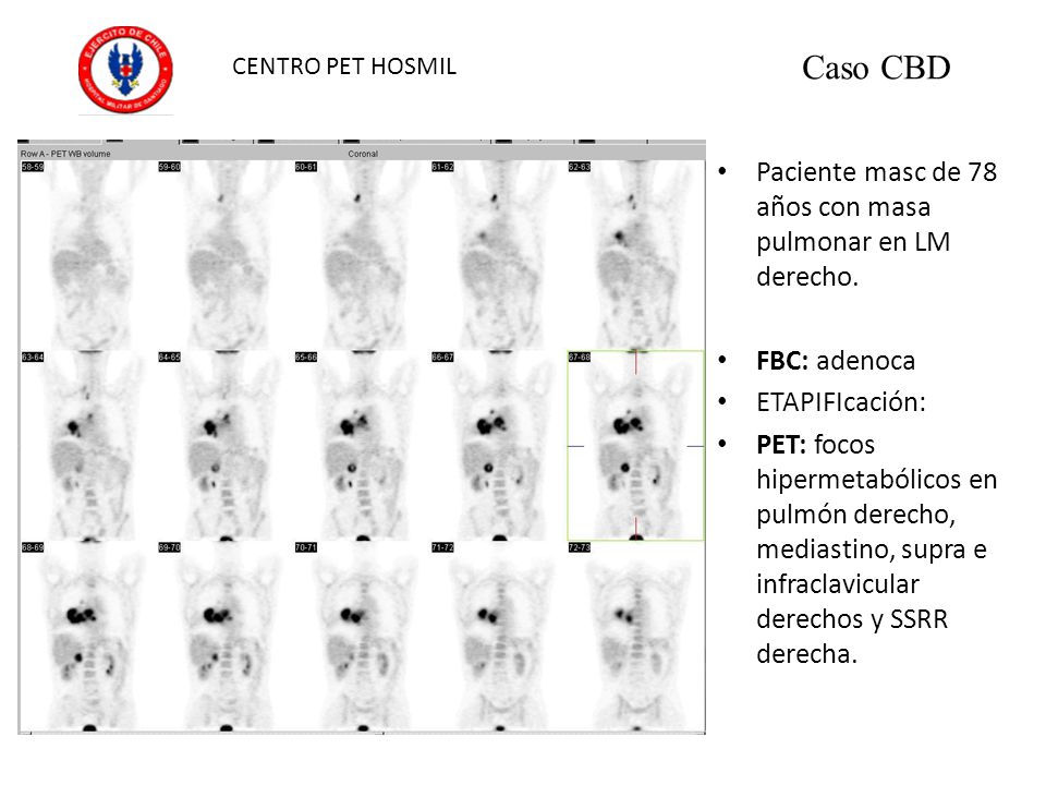 Caso CBD Paciente masc de 78 años con masa pulmonar en LM derecho.