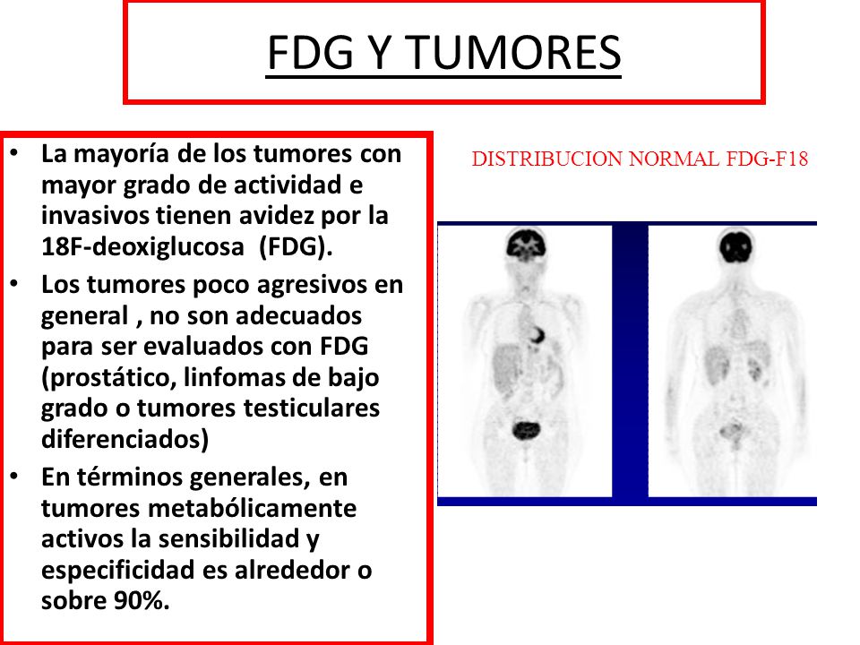 FDG Y TUMORES La mayoría de los tumores con mayor grado de actividad e invasivos tienen avidez por la 18F-deoxiglucosa (FDG).